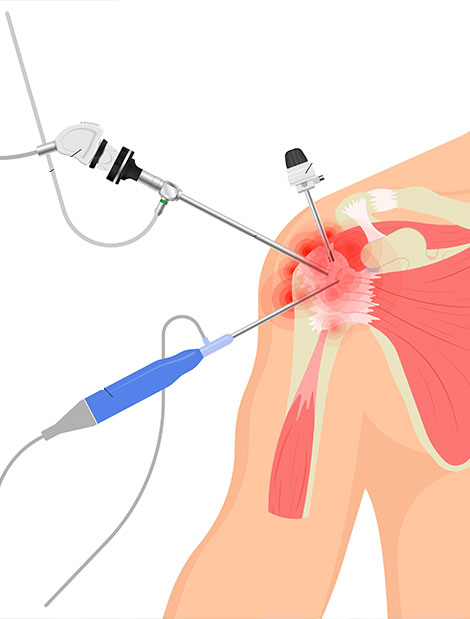 arthroscopie épaule