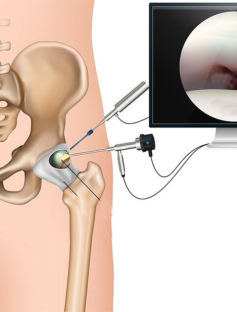 arthroscopie de hanche