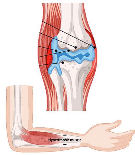 Arthrose du coude