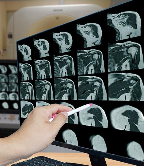 diagnostic rupture coiffe