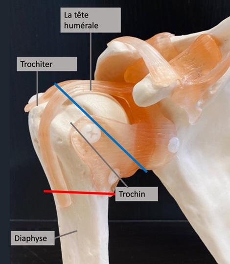 fracture de tête humérale