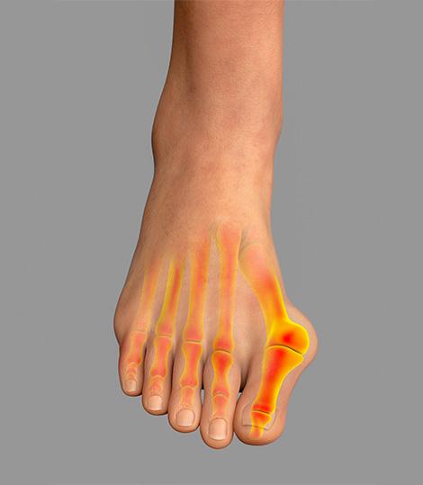 hallux valgus