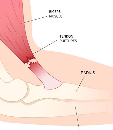 rupture distale biceps