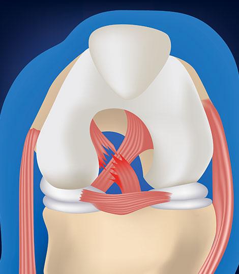 Rupture du ligament croisé antérieur