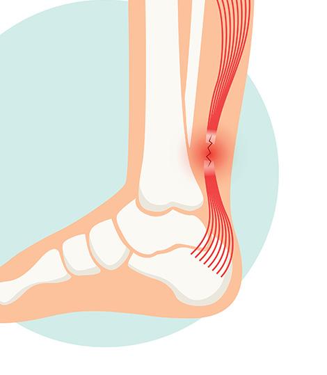 rupture du tendon d'achille